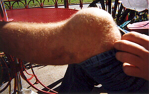 bigknee